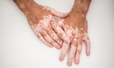 Dark Circles & Stretch Marks